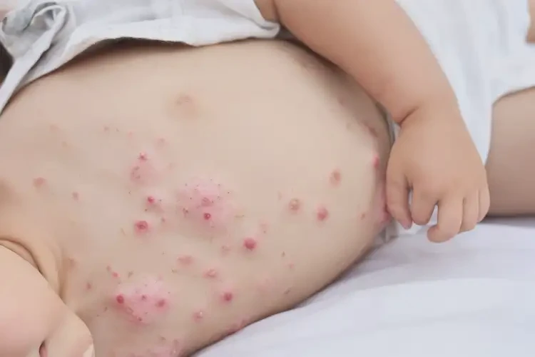 少兒肚子有濕疹可不可以根治(圖4)