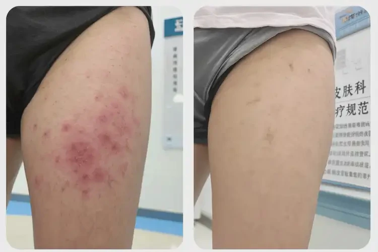 小孩肛周偶尔起湿疹可以治好吗(图2)