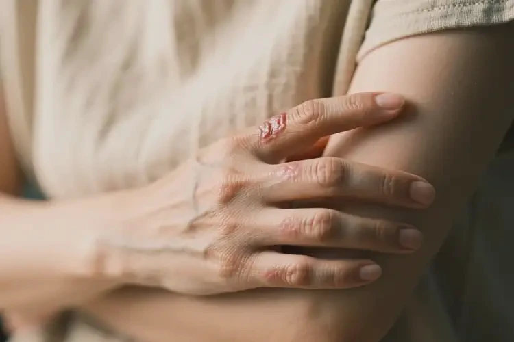 女性身上偶爾長濕疹可不可以根治(圖1)