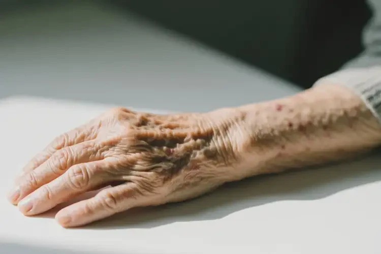 老人手臂上出現(xiàn)濕疹可以治好嗎(圖1)