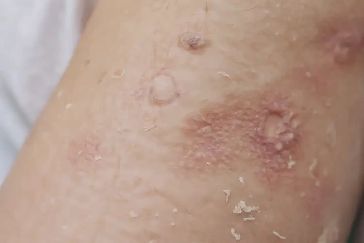 產婦手臂經(jīng)常長濕疹能夠徹底治愈嗎(圖4)