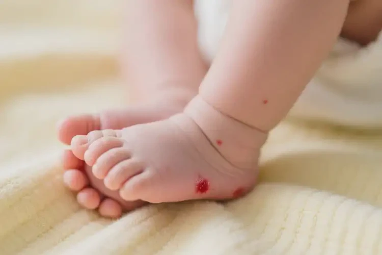 新生兒腳上容易長(zhǎng)濕疹可不可以根治(圖1)