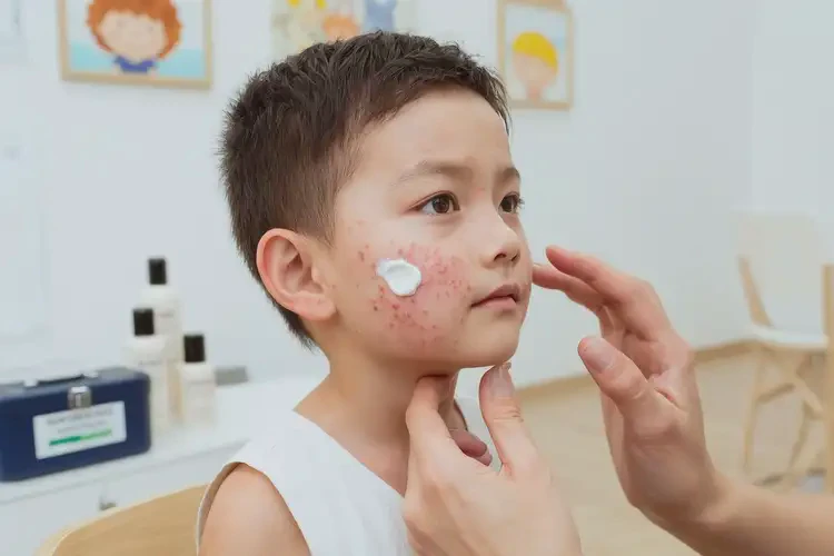 少兒臉上偶爾長(zhǎng)濕疹可不可以徹底自愈(圖3)