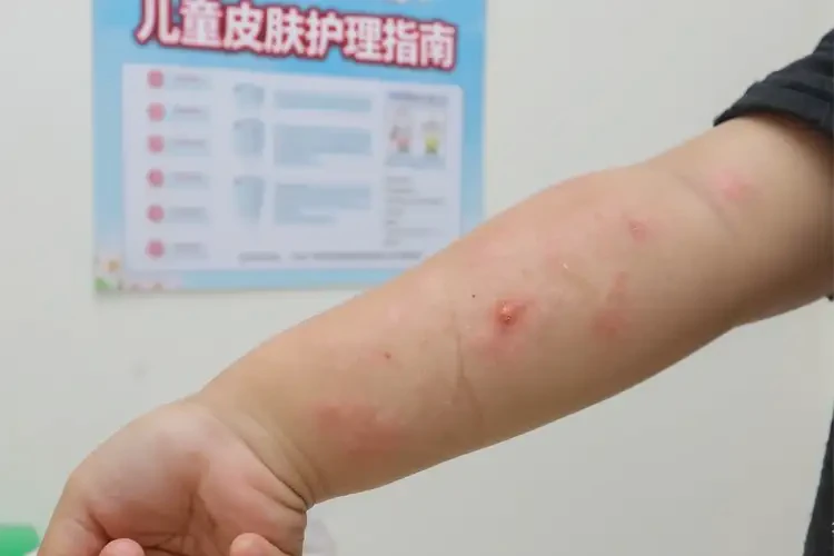 孩子身上容易長濕疹可不可以根治(圖4)