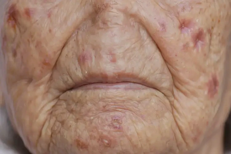 高齡老人全身經(jīng)常起濕疹可不可以根治(圖4)