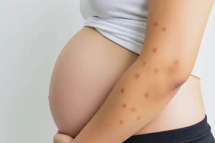 孕婦手臂有濕疹可以治好嗎(圖4)