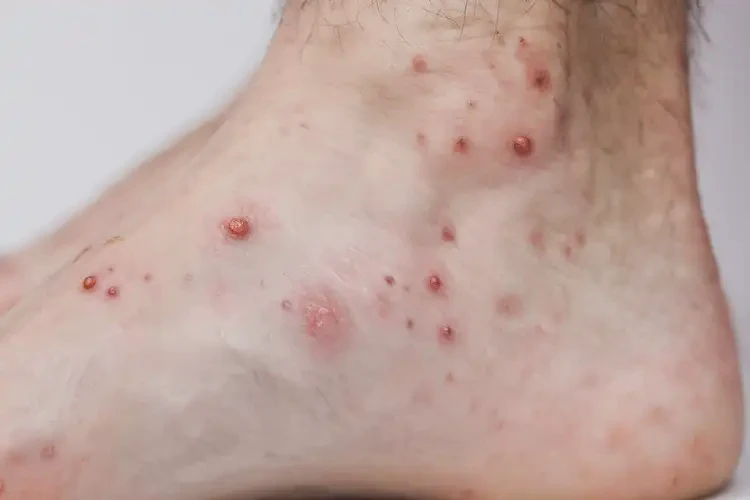 青年人腳上經(jīng)常長濕疹可不可以根治(圖4)
