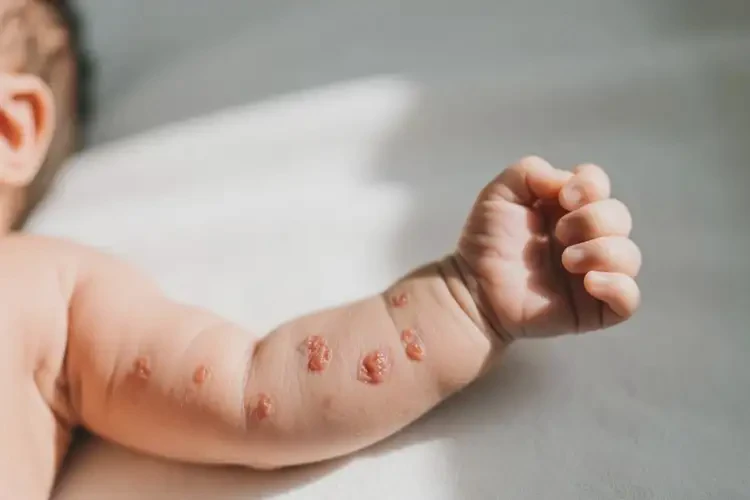 新生兒手臂偶爾長濕疹可不可以根治(圖2)
