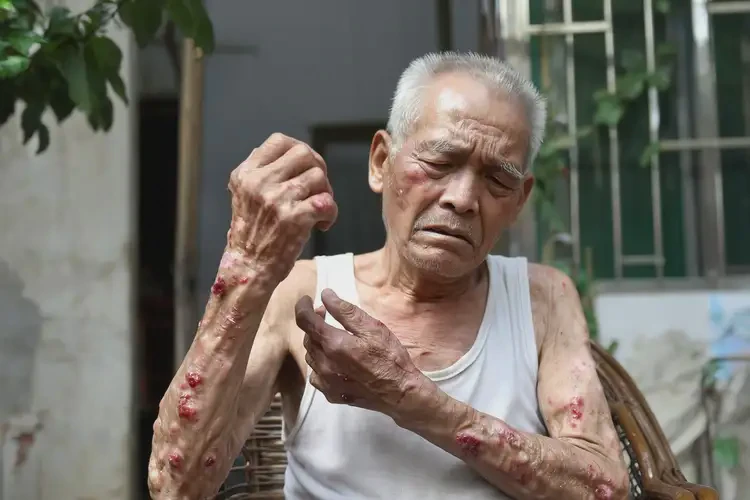 高齡老人身上容易長濕疹可不可以根治(圖4)