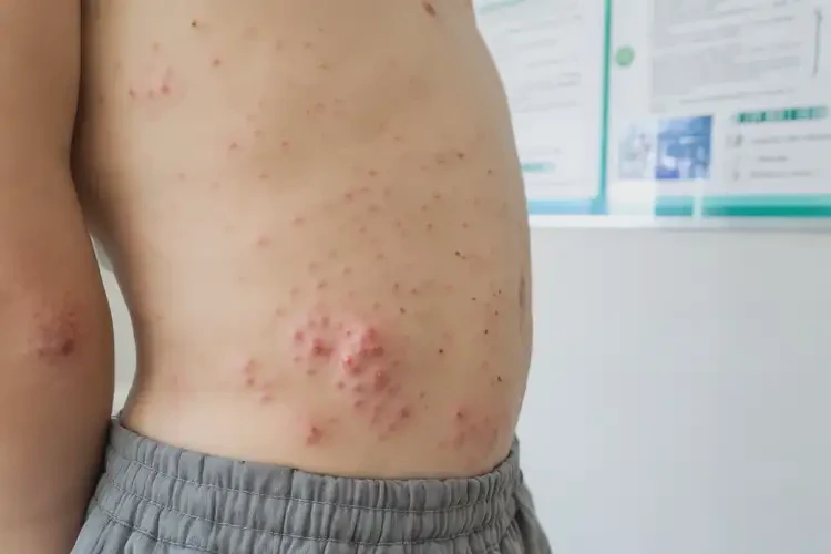 青少年屁股上容易長(zhǎng)濕疹不管它會(huì)自己自愈嗎(圖4)