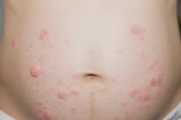 產(chǎn)婦肚子偶爾長濕疹可不可以根治(圖4)