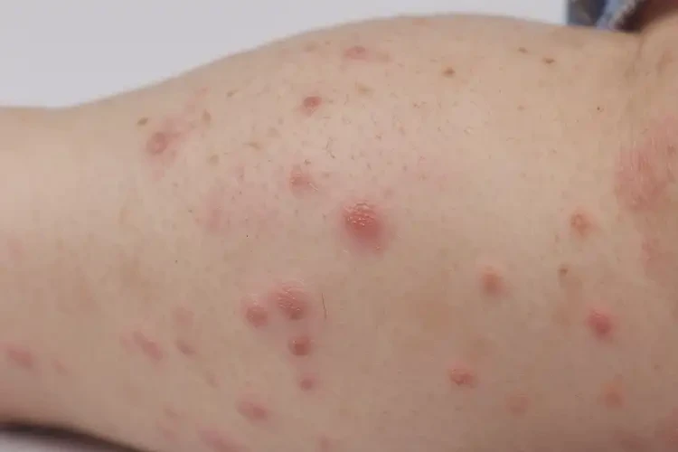 少兒小腿上偶爾長(zhǎng)濕疹可以治好嗎(圖4)