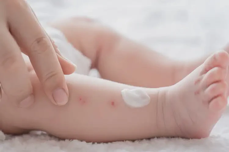 新生兒小腿上起濕疹可不可以根治(圖3)
