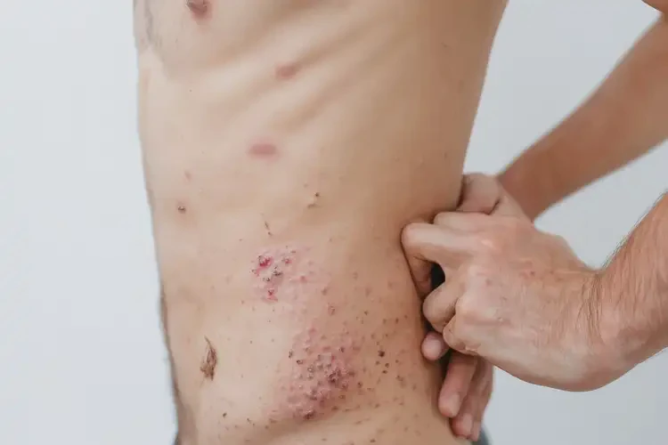 青年人屁股上容易起濕疹可不可以根治(圖4)