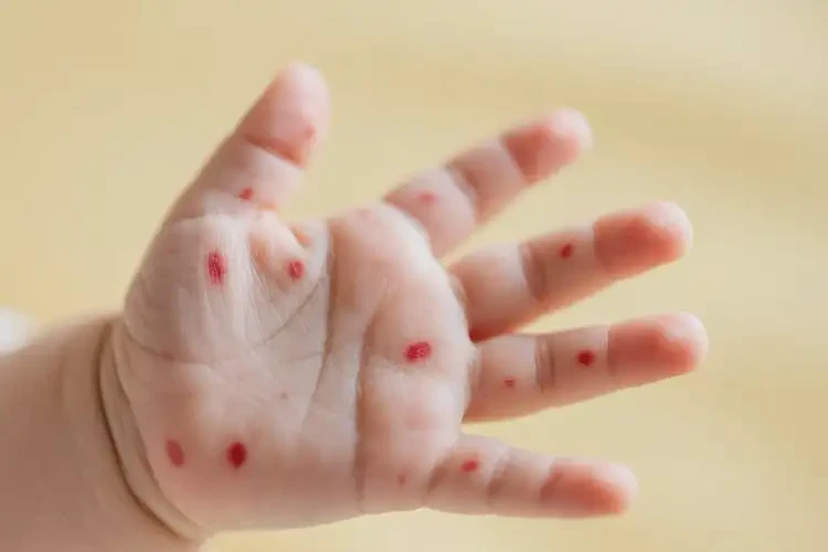 嬰幼兒手上偶爾起濕疹可以治好嗎(圖3)