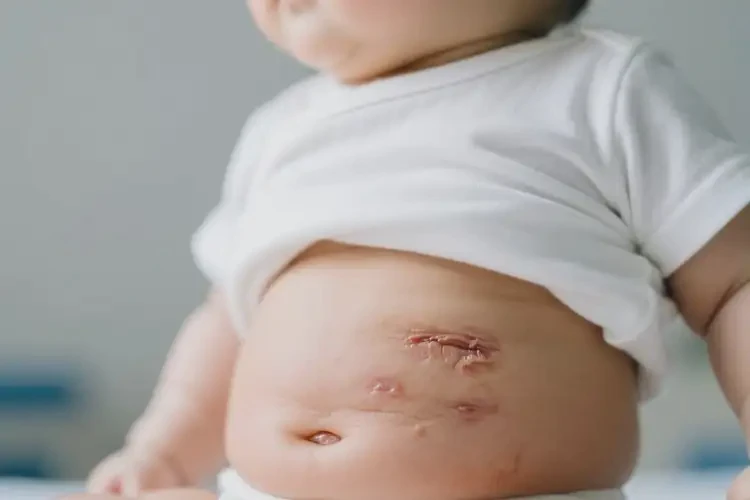 寶寶肚子上出現(xiàn)濕疹可以治好嗎(圖1)
