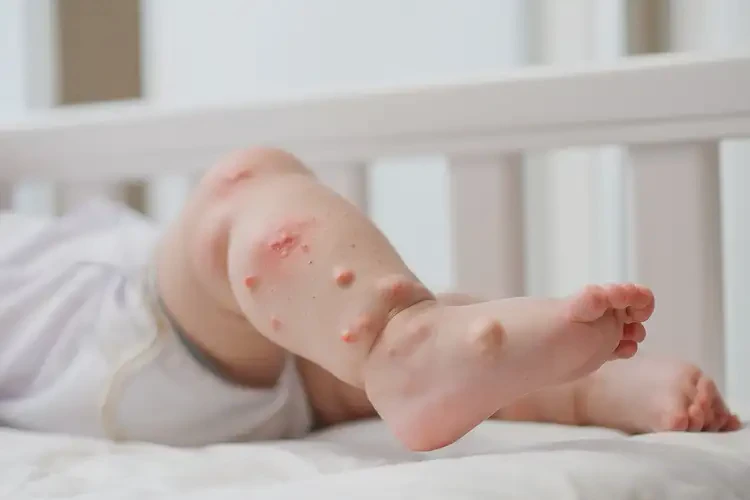 嬰兒小腿上經(jīng)常長濕疹可以治好嗎(圖4)