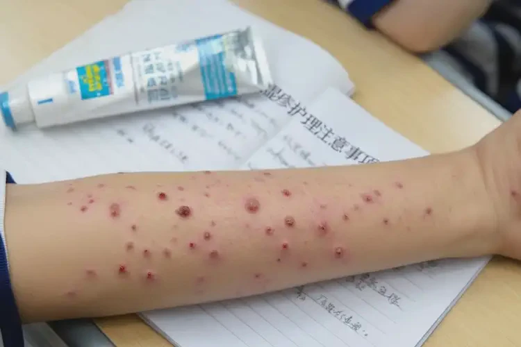 中學生手臂上有濕疹可不可以根治(圖4)