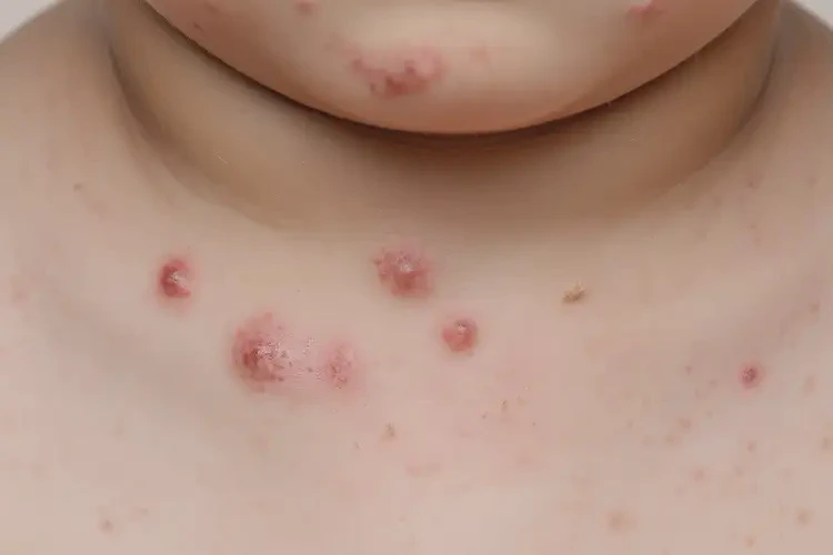 少兒脖子上出現(xiàn)濕疹可以治好嗎(圖4)