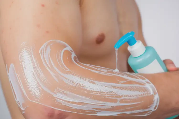 男生手臂容易起湿疹可不可以根治(图2)