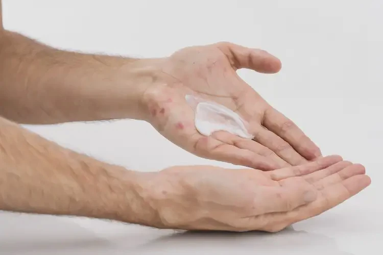 青年人手上容易長(zhǎng)濕疹不管它會(huì)自己好嗎(圖1)