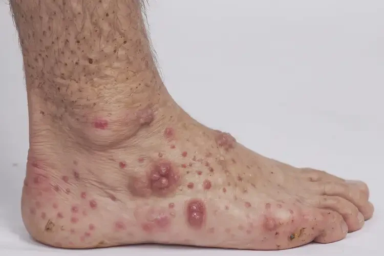 男性腳上出現(xiàn)濕疹可不可以徹底自愈(圖4)