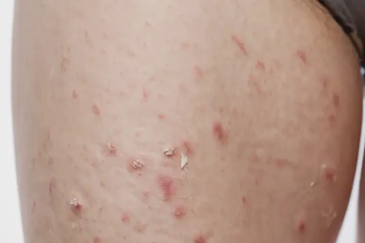 女人大腿起濕疹可不可以根治(圖3)