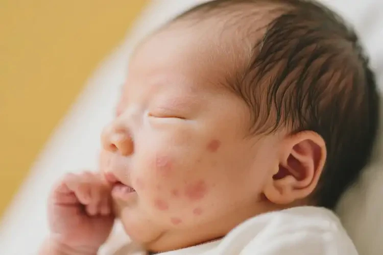 新生兒面部經(jīng)常長(zhǎng)濕疹可不可以根治(圖2)