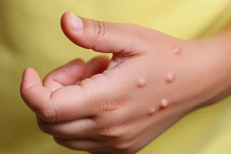 兒童手上出現(xiàn)濕疹可以治好嗎(圖2)