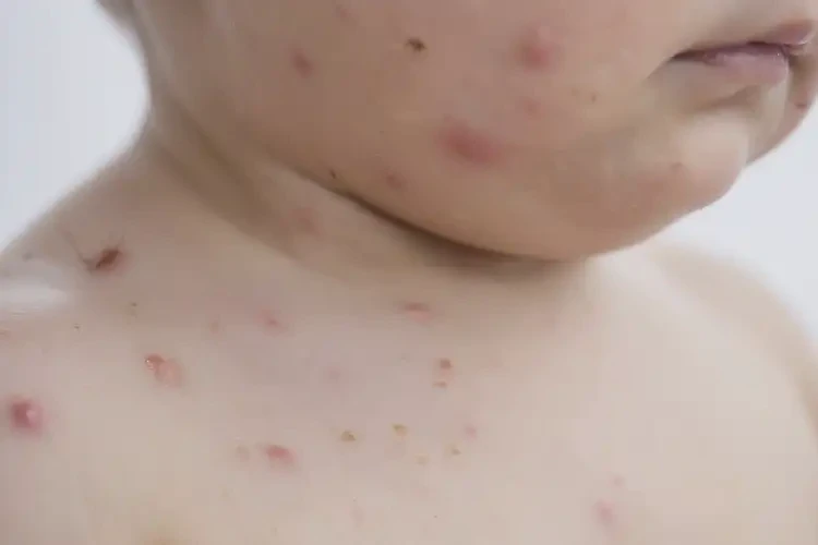 小孩脖子上出濕疹可不可以根治(圖4)