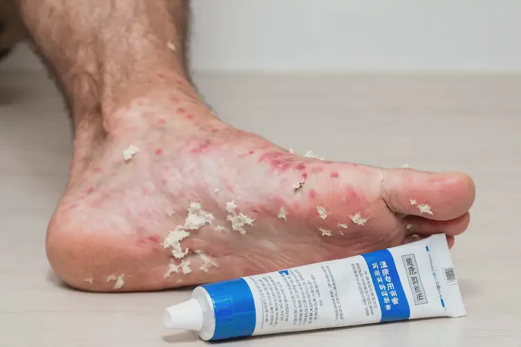 哺乳期媽媽腳上容易長(zhǎng)濕疹可不可以根治(圖3)