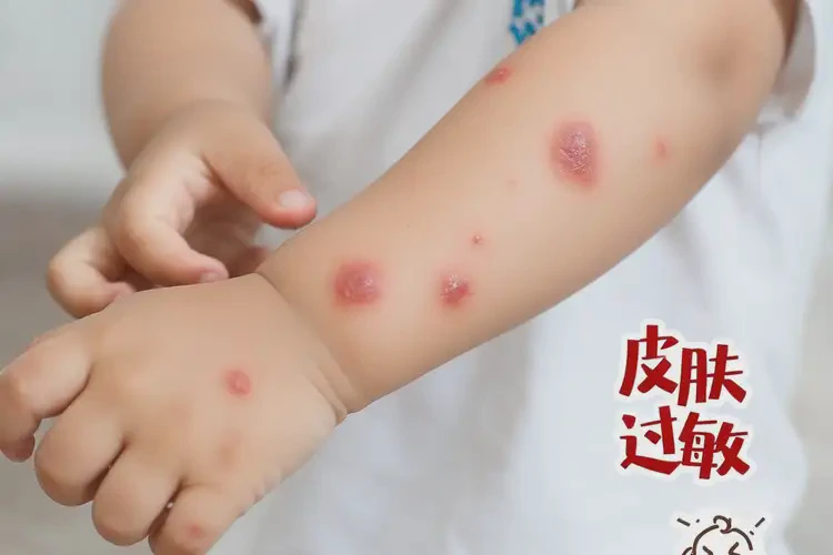 小孩屁股有濕疹可以治好嗎(圖4)