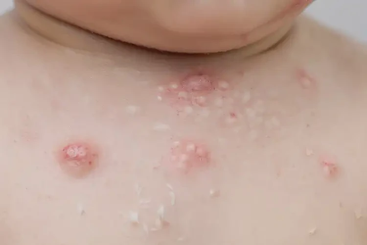小兒脖子上經(jīng)常起濕疹可以治好嗎(圖4)