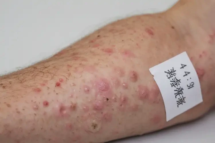 男人手臂上偶爾起濕疹可不可以根治(圖4)