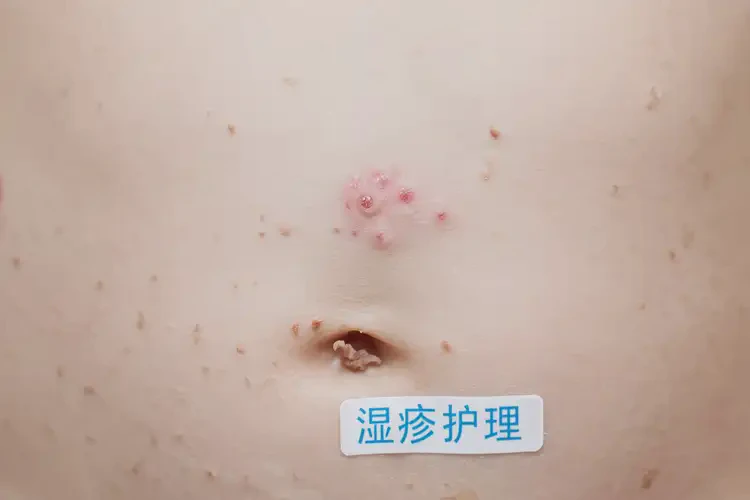 幼兒肚子長(zhǎng)濕疹可不可以根治(圖4)