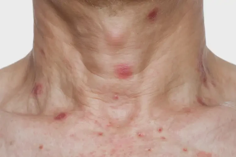 男人脖子上出湿疹可不可以根治(图4)