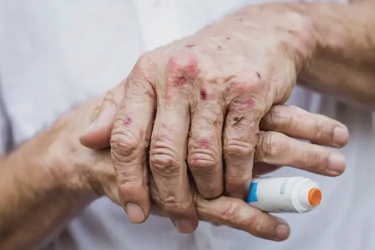 高齡老人手上偶爾起濕疹可不可以根治(圖4)