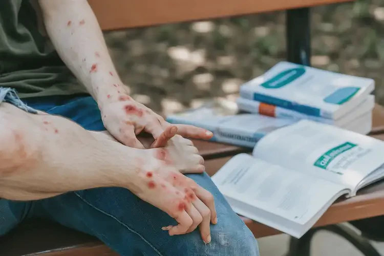 大學生小腿經(jīng)常長濕疹可不可以根治(圖4)