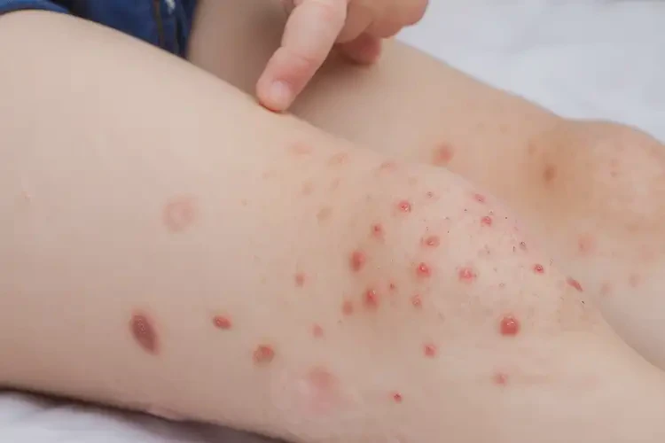 孩子大腿起濕疹可不可以根治(圖4)