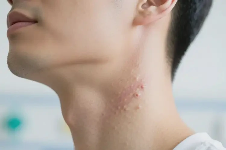 男性脖子有濕疹可以治好嗎(圖4)