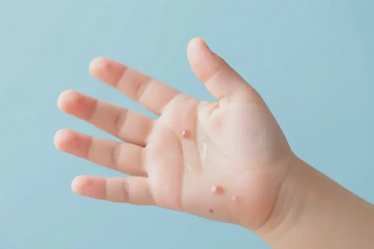 小兒手上容易起濕疹可以治好嗎(圖2)