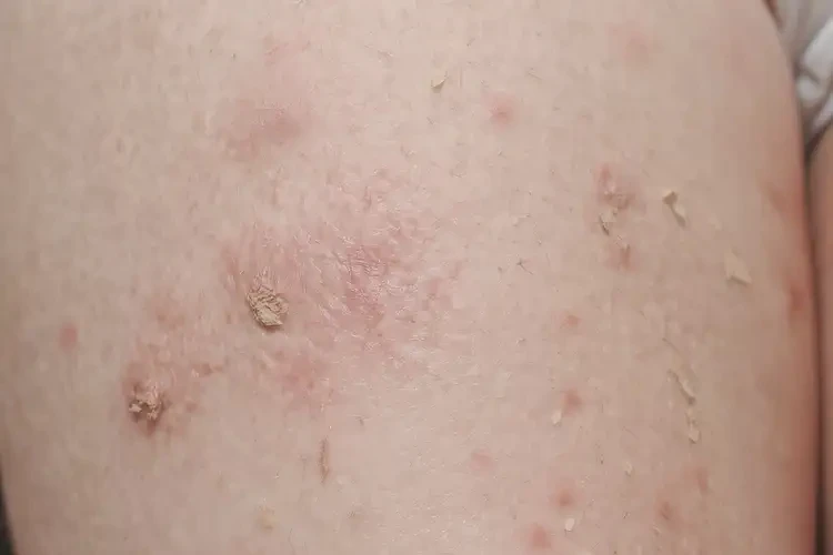 小兒大腿起濕疹可不可以根治(圖4)