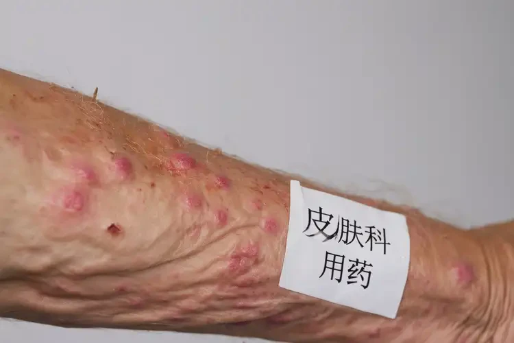 老年人手臂经常长湿疹可不可以根治(图4)