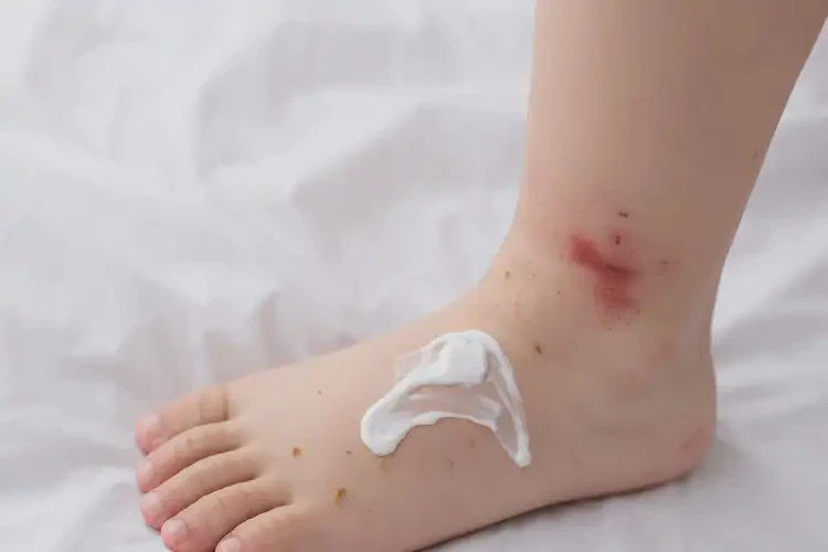 小兒腳上經(jīng)常長(zhǎng)濕疹可不可以根治(圖3)