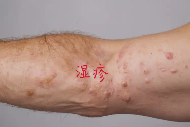 男性手臂上起濕疹可不可以根治(圖4)