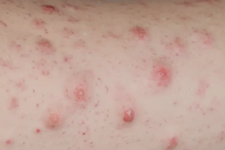 女生大腿出濕疹不管它會(huì)自己自愈嗎(圖3)