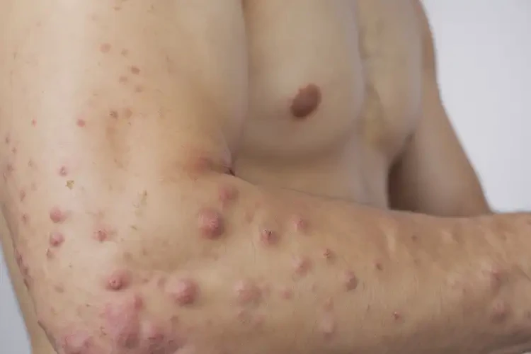 男生手臂容易起湿疹可不可以根治(图3)