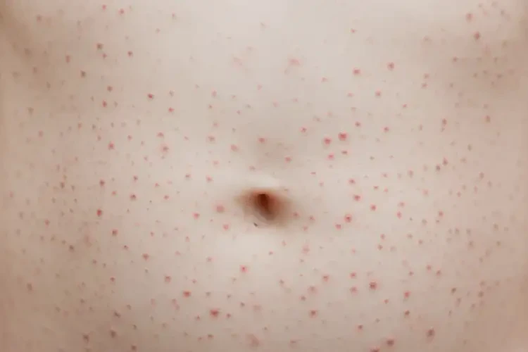 小學(xué)生肚子上有濕疹可不可以徹底自愈(圖3)