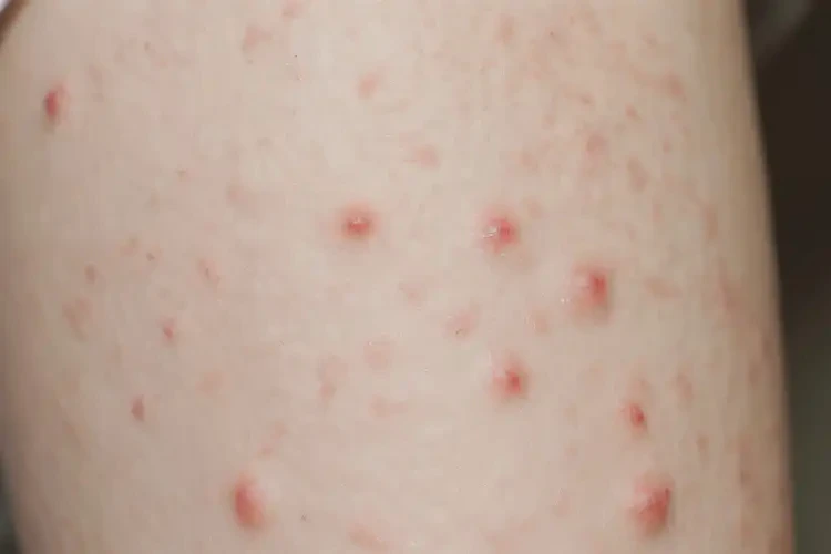 中學(xué)生小腿偶爾起濕疹可不可以根治(圖4)