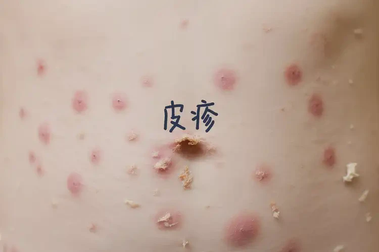 少兒肚子上出濕疹能靠自己自愈嗎(圖4)